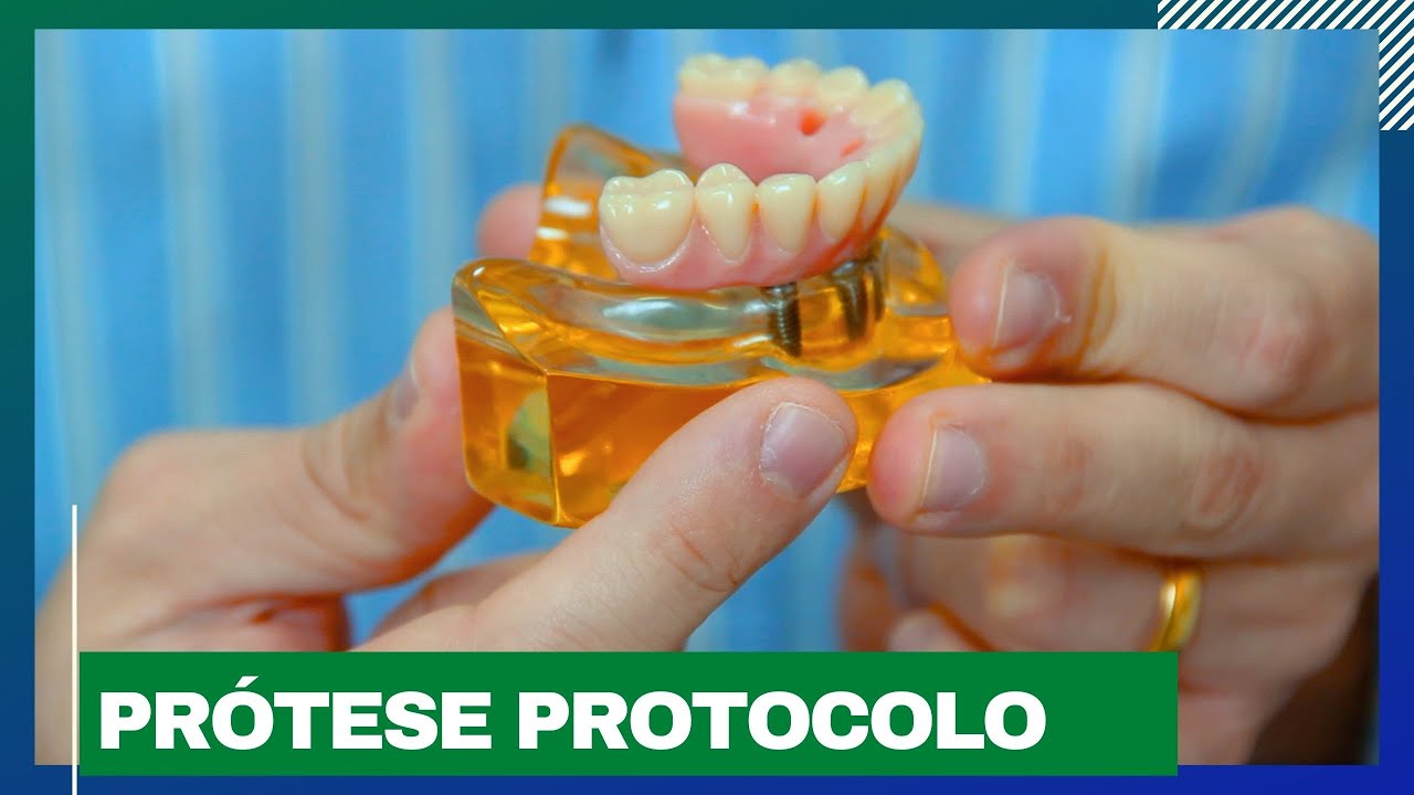 PORQUE A PRÓTESE PROTOCOLO SÓ TEM 12 DENTES ? DR. GUILHERME FELIX