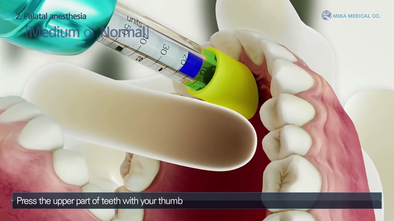 Dental injection by Comfort-in Training