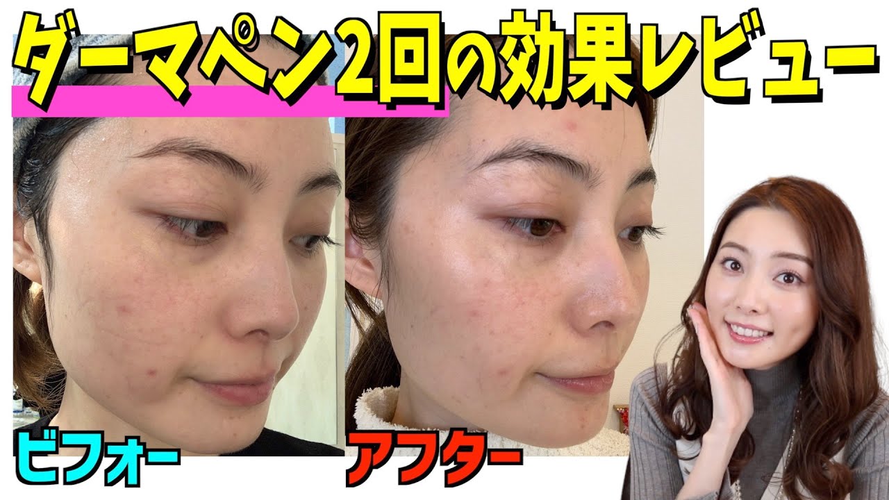 【ダーマペン2ヶ月密着】経過報告します！ダウンタイムにオススメのコスメも紹介します✨