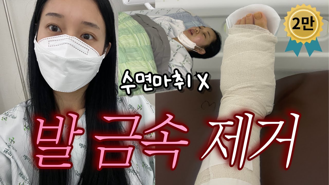 [vlog] 발 금속 제거 수술 브이로그 | 리얼 다큐 | 이제 뼈만 잘 채워지면 돼 | 발 골절 수술 | 수술 브이로그
