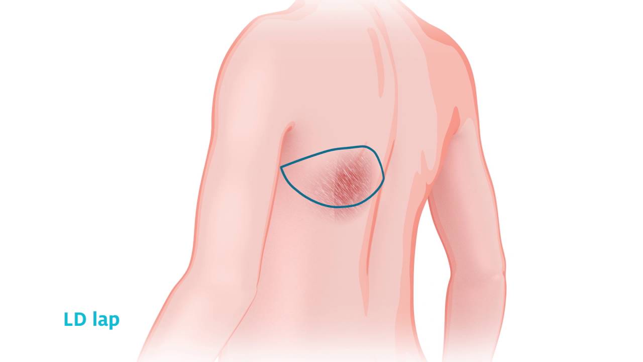 Radboudumc borstreconstructie LD lap