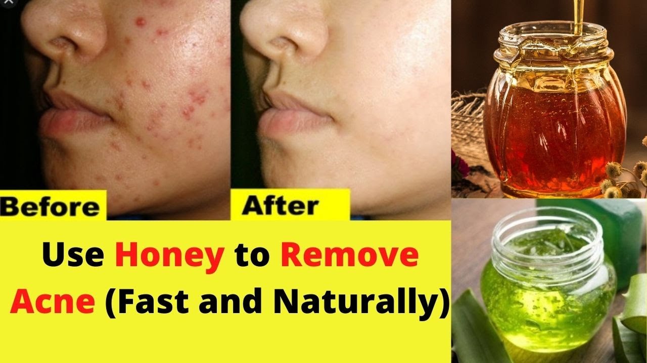 How to Use Honey to Remove Acne (Fast and Naturally) | Get Clear Skin | Miss Fit Fighter