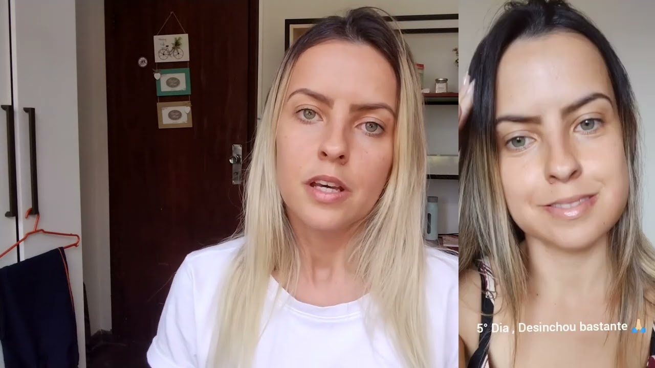 Parestesia lábio e queixo, Tratamento,melhorou??? 