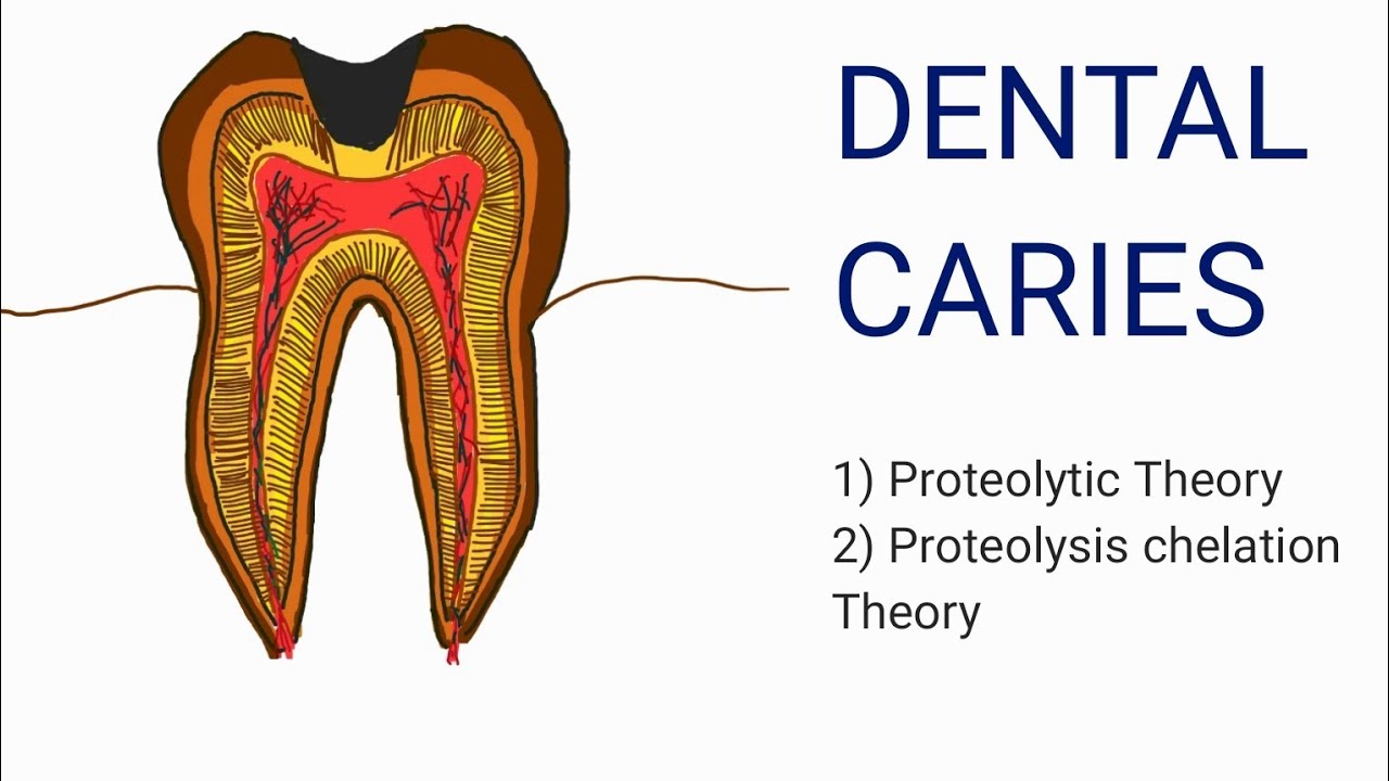 DENTAL CARIES PART 2( Proteolytic theory and proteolysis chelation theory)