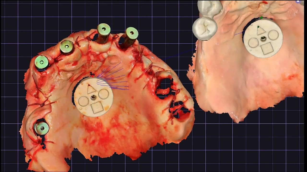 Full arch full digital: jd implants- jd tracer modified by Dr. Costa - intraoral photogrammetry