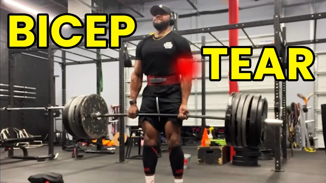 Distal Bicep Rupture (Bicep Tear Rehabilitation)