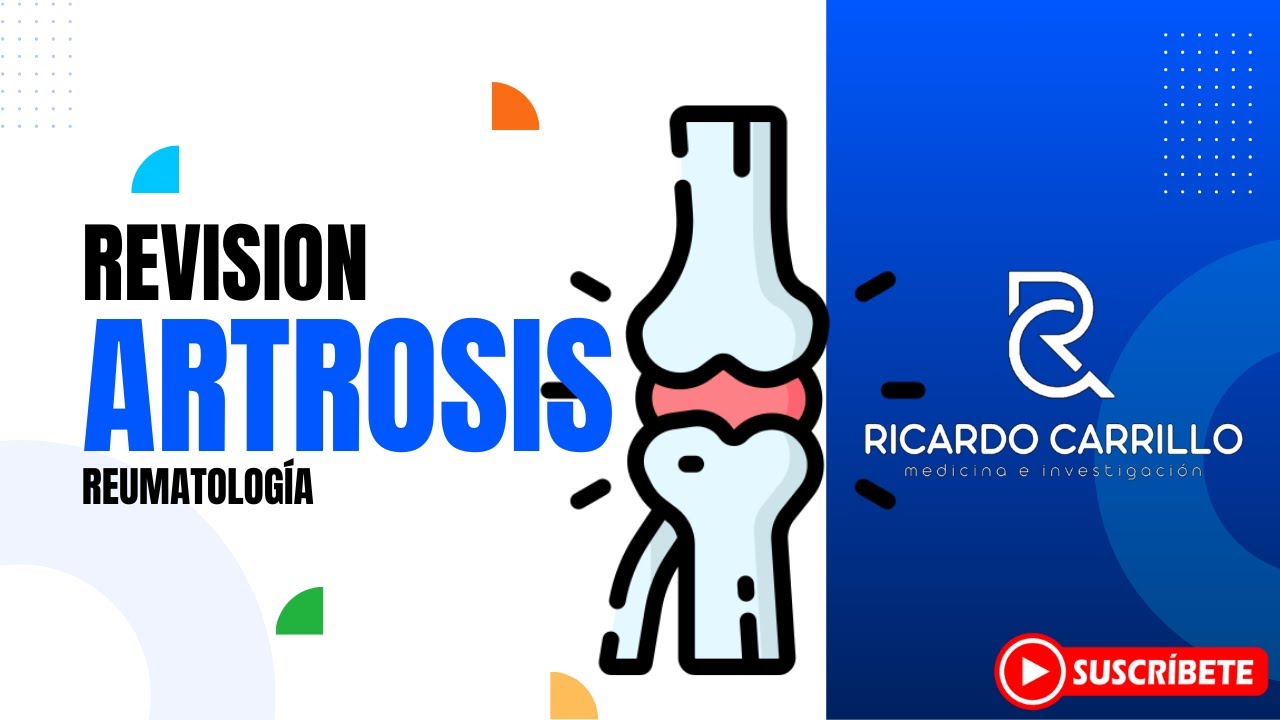 Osteoartrosis l Reumatolog&iacute;a