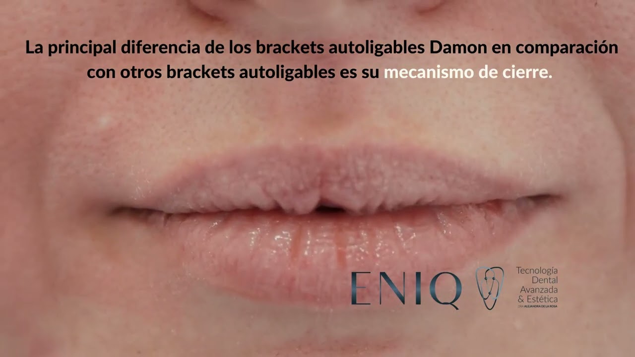 BRACKETS AUTOLIGABLES .