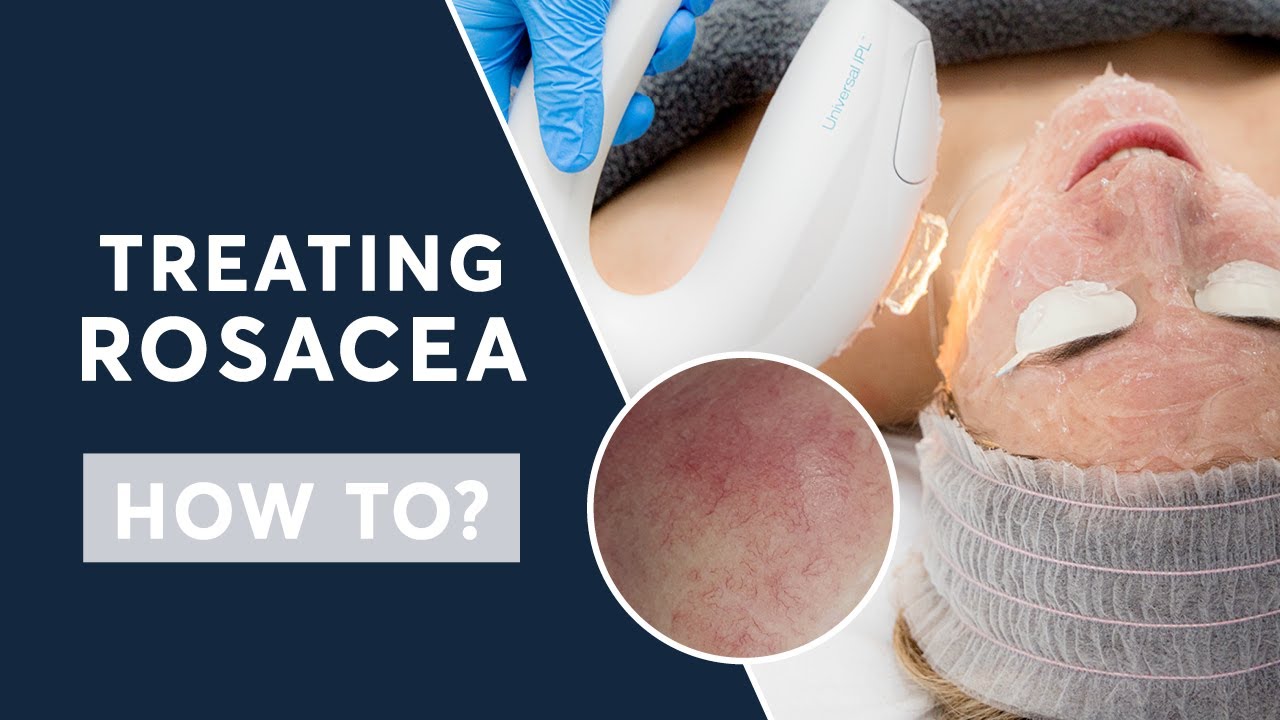 HOW TO: Treat Rosacea | London