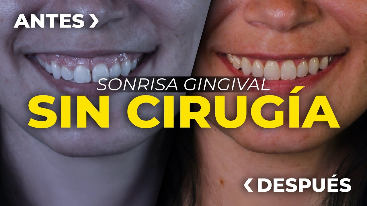 De SONRISA GINGIVAL ➡️ a SONRISA PERFECTA (SIN CIRUGÍA) - Clínica Peydro Herrero