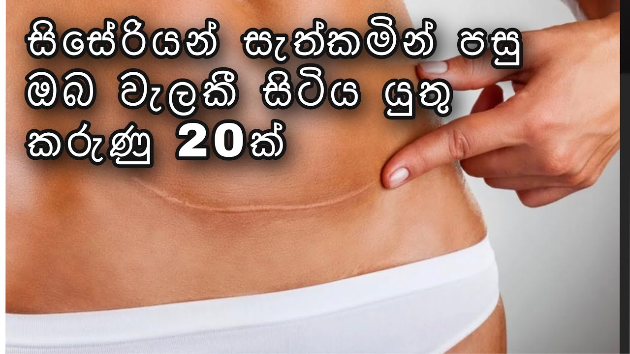 සිසේරියන් සැත්කමින් පසු ඔබ වැළකී සිටිය යුතු කරුණු 20 ක්