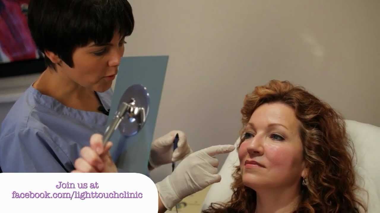 Removing Red Veins form the Face Permanently