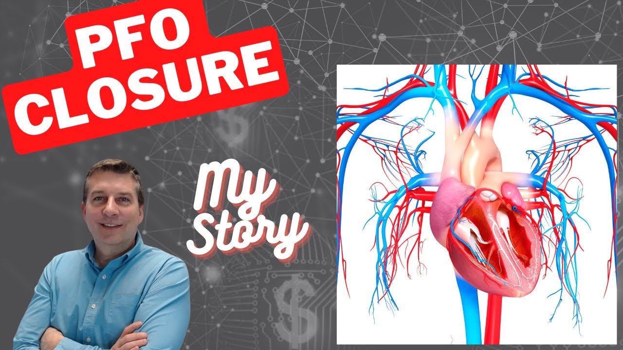 My PFO Closure Story - Patent Foramen Ovale Closure - Post Stroke
