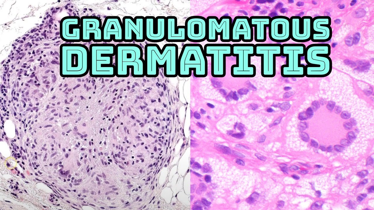 Granulomatous Dermatitis 101 Board Review (dermpath dermatology pathology granuloma sarcoidosis)