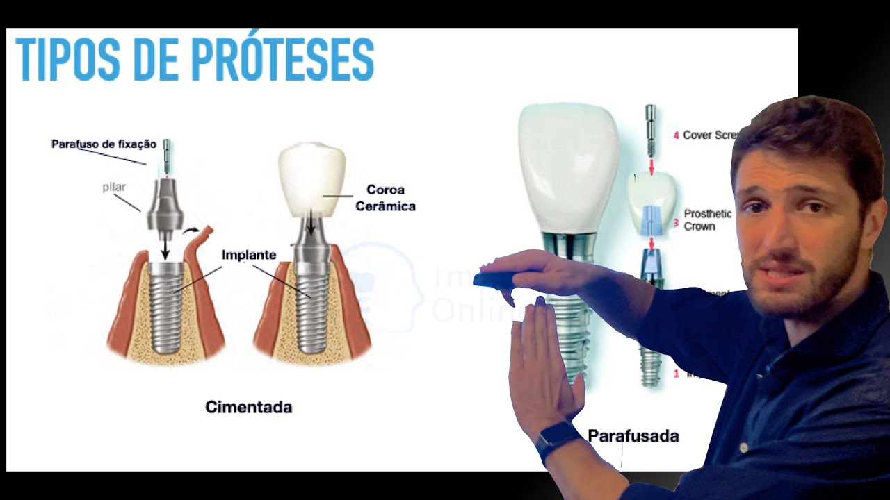 Tipos de prótese em Implantodontia - Cimentadas, Parafusadas, Unitárias ou Múltiplas