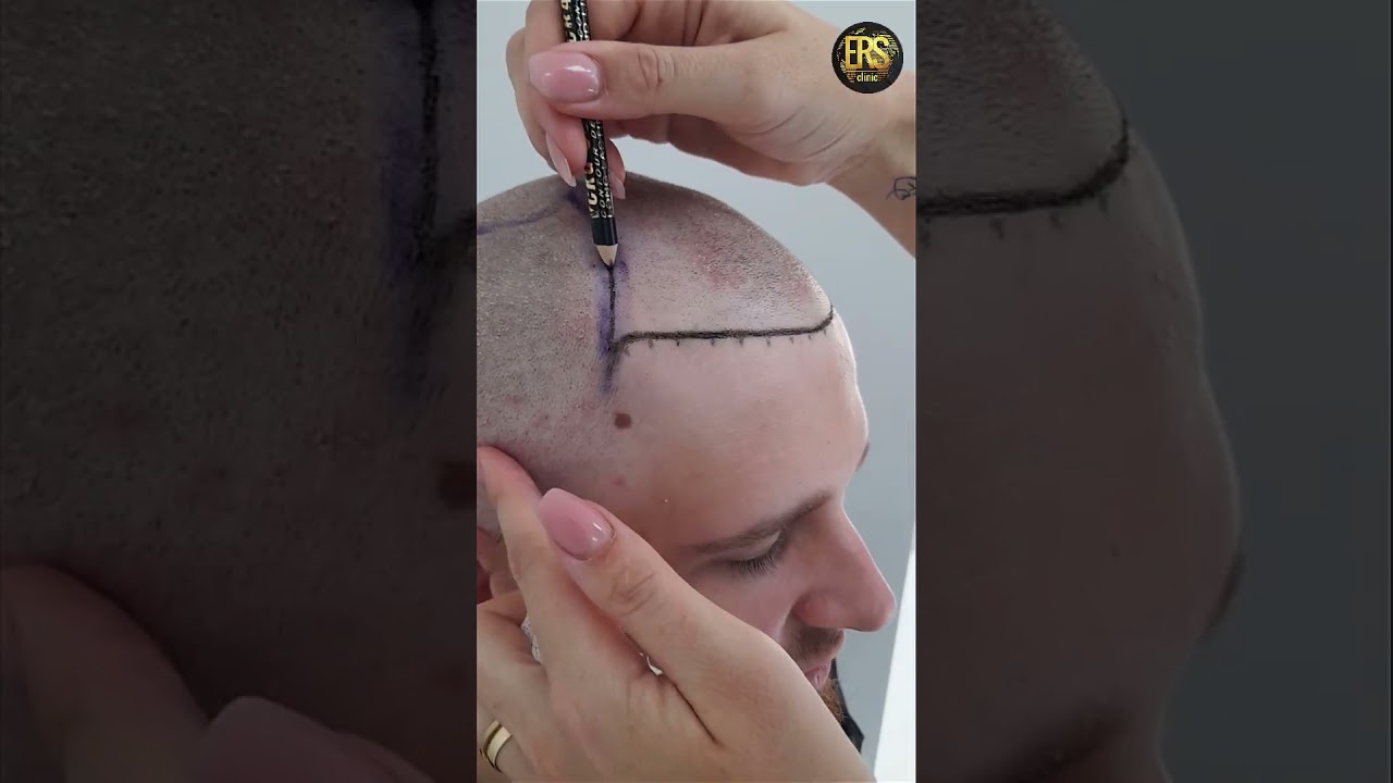 Hair transplant Istanbul Turkey ERS CLİNİC  #hairtransplant #sacekimi #kellik #hair #baldness #bald