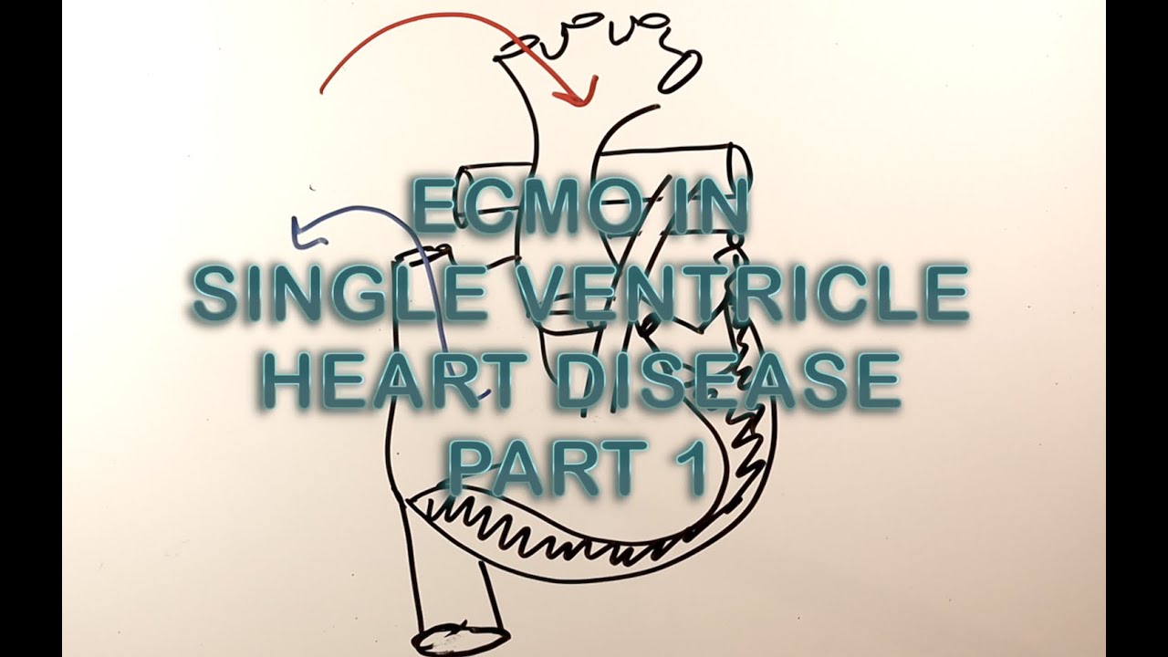 ECMO cannulation in CHD-interstage