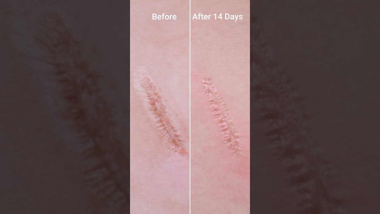 Use aloe vera to help reduce scars #shorts