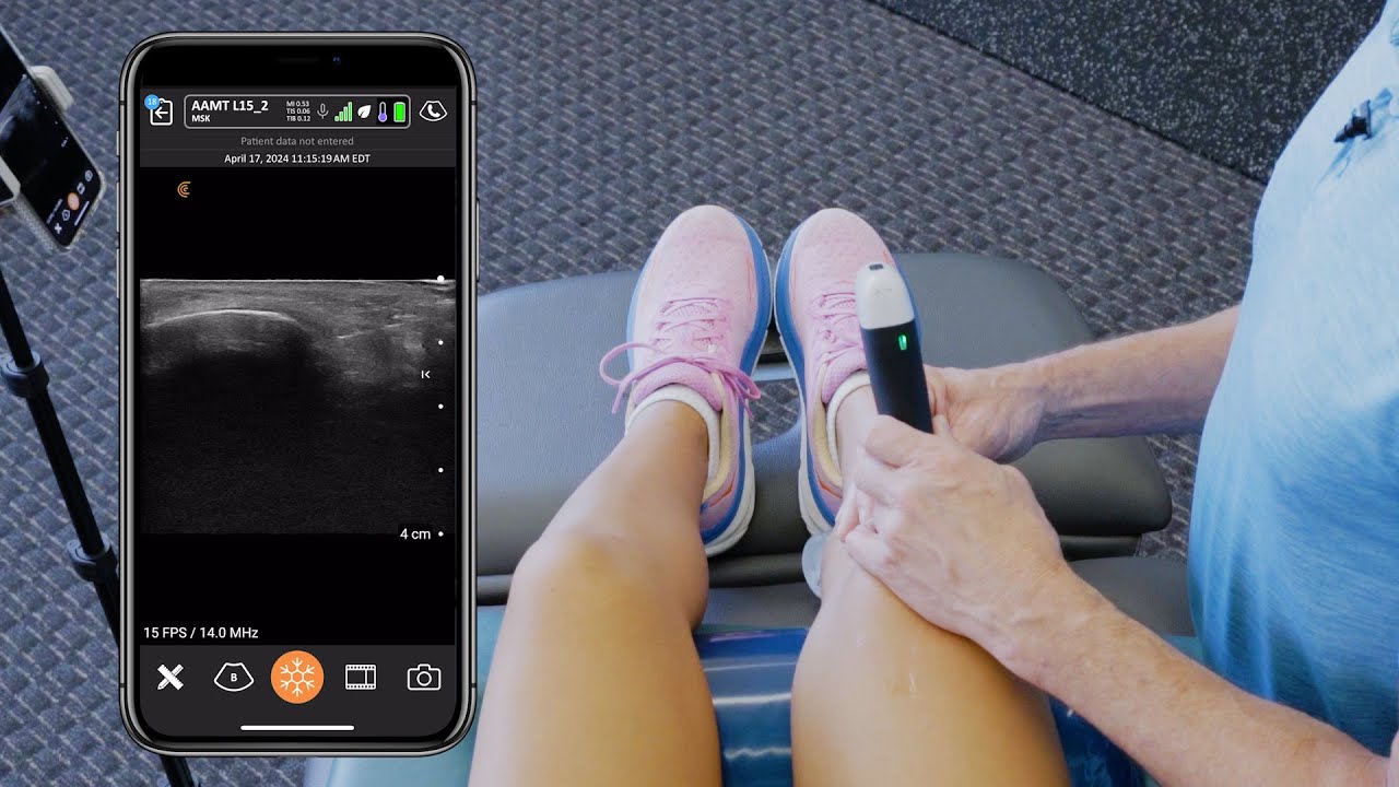 USG Dry Needling Patellar Tendon