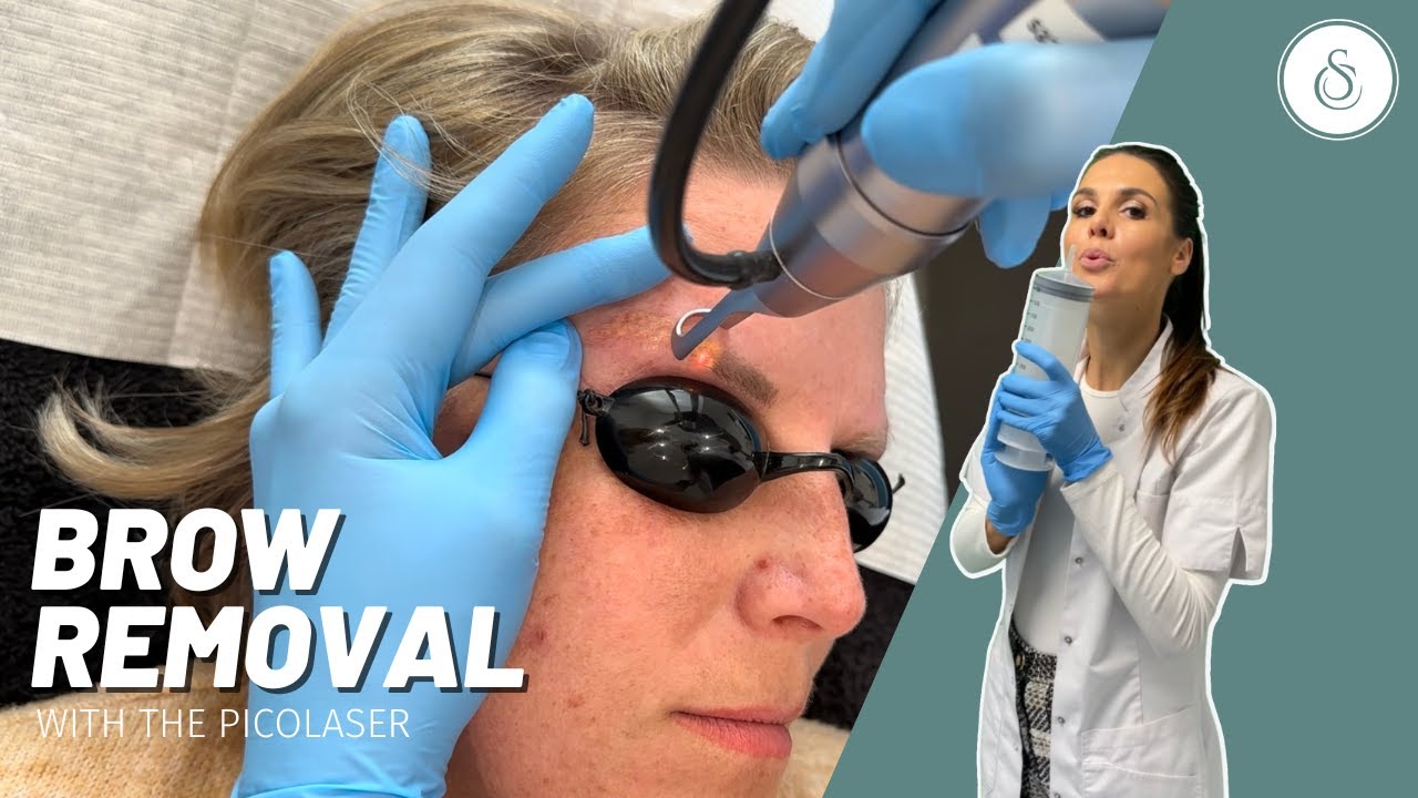 Brow Laser Removal with the Picolaser ⚡️