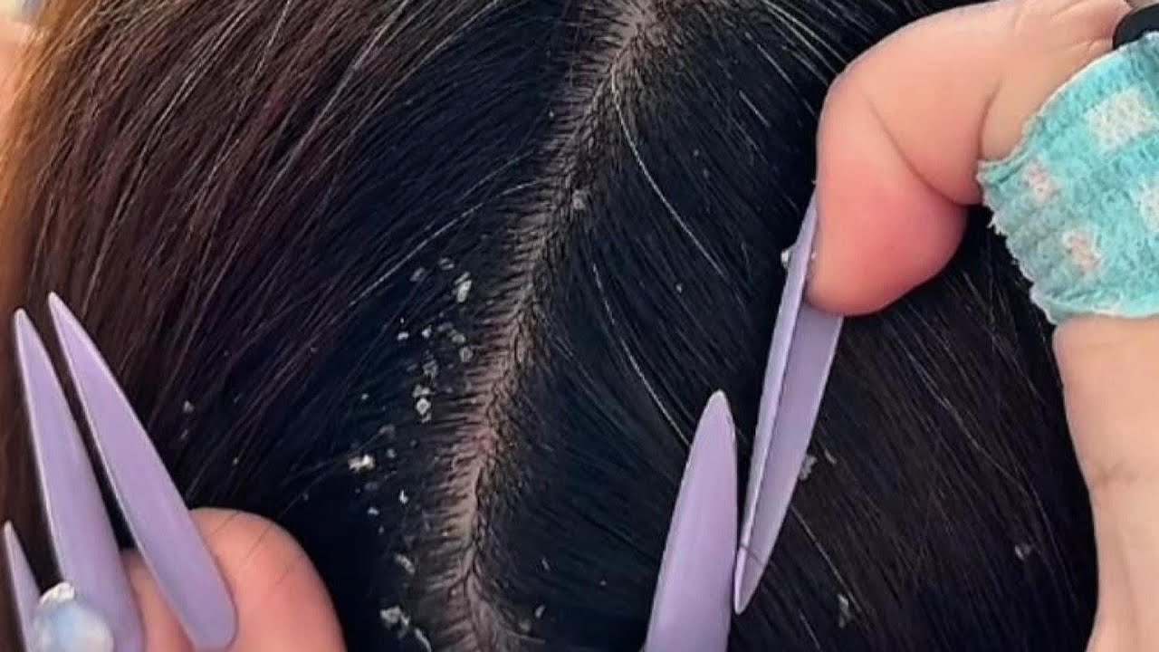 4 Hours of Dandruff Scratching & Flake Picking | ASMR Nails + Tweezers