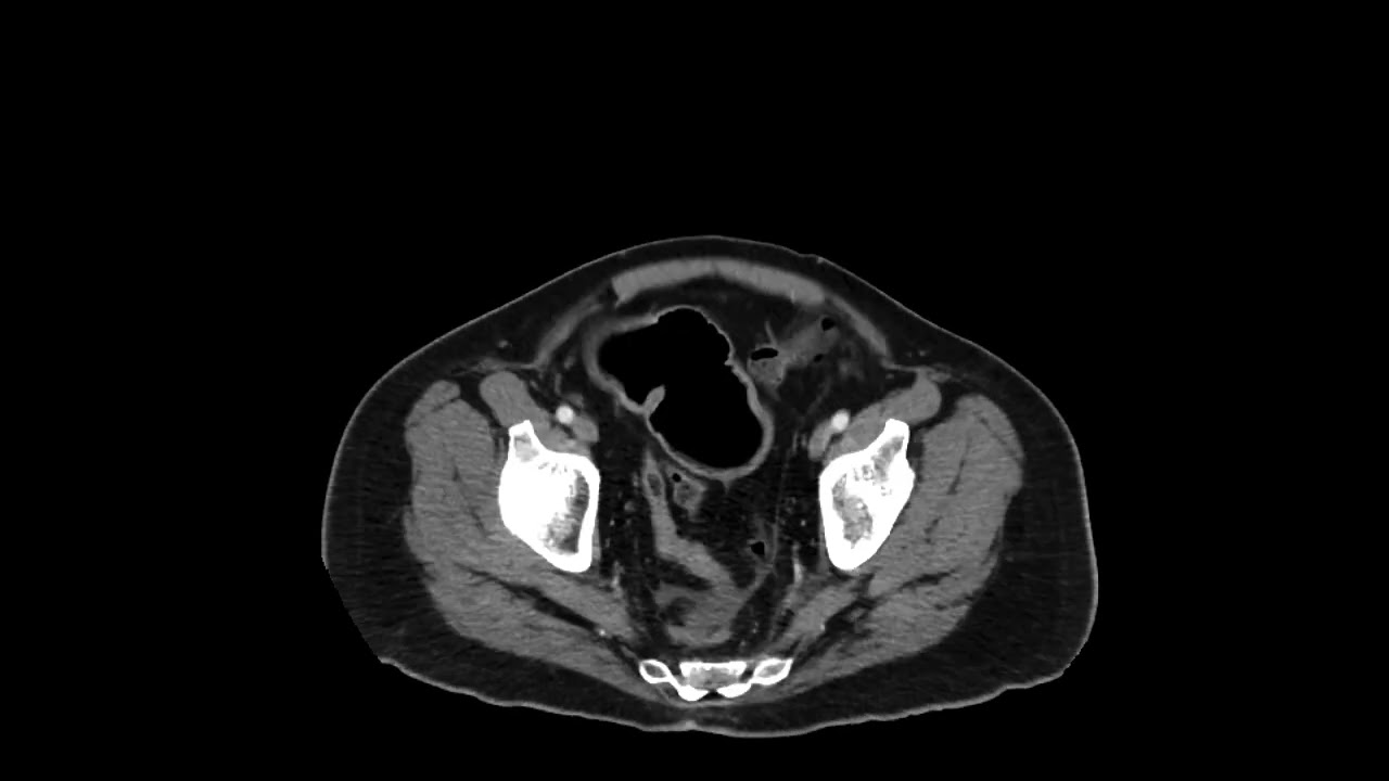 Cecal cancer causing SBO