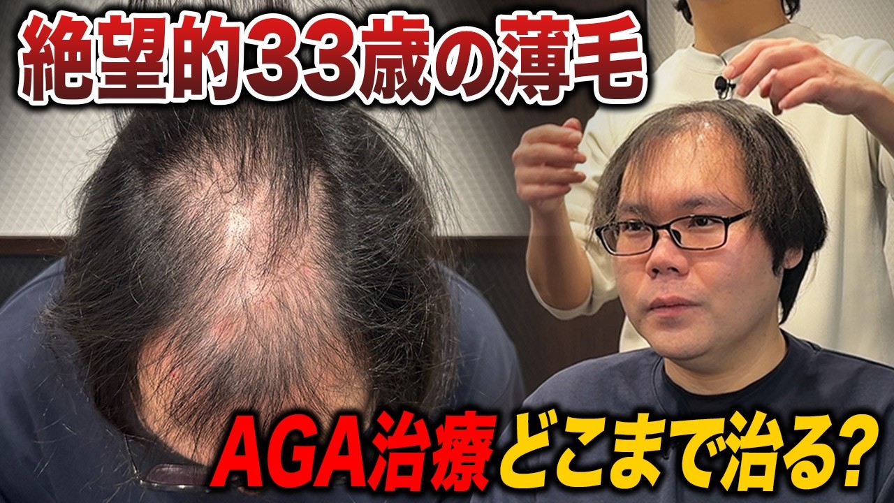 【30代薄毛】AGA治療薬でどこまで改善できるのか...！