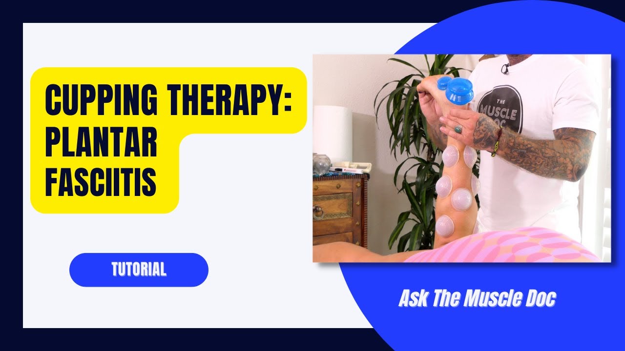 Dynamic Sports Cupping Therapy: Plantar Fasciitis -Ask The Muscle Doc