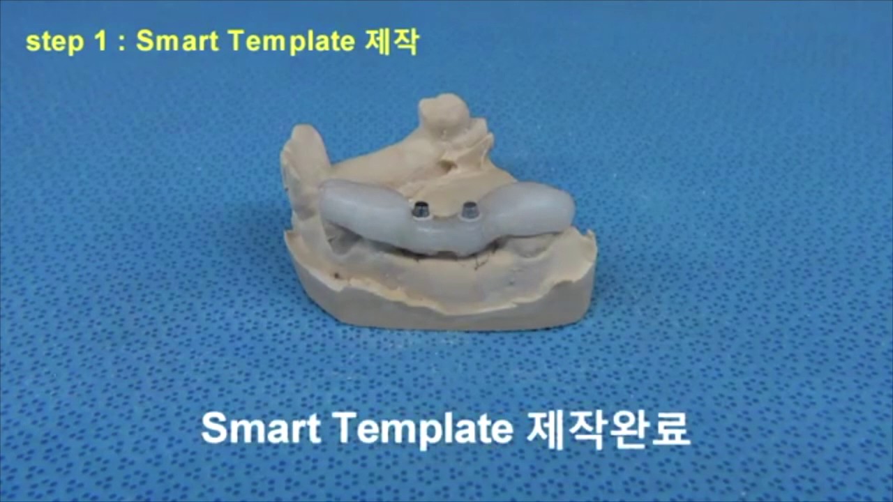 SmartGuide KIT OSSTEM Bohrschablone Implantologie