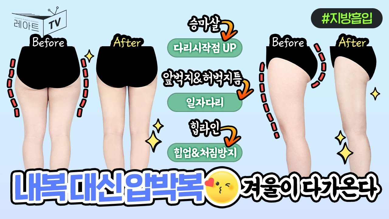 [허벅지지방흡입] 찬바람 부는데 압박복 안입으실 꼬에염?🥶 [레아트성형외과]