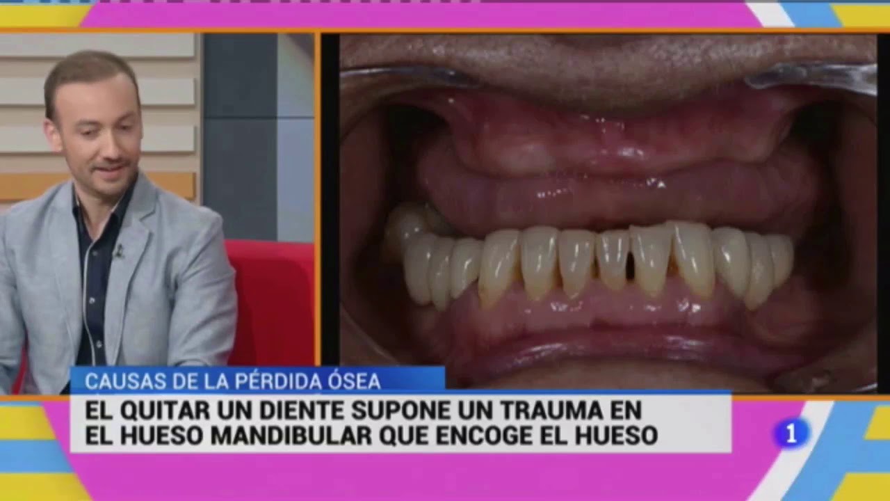 La perdida de hueso en la boca (Cerca de ti TVE. Marzo 2018)