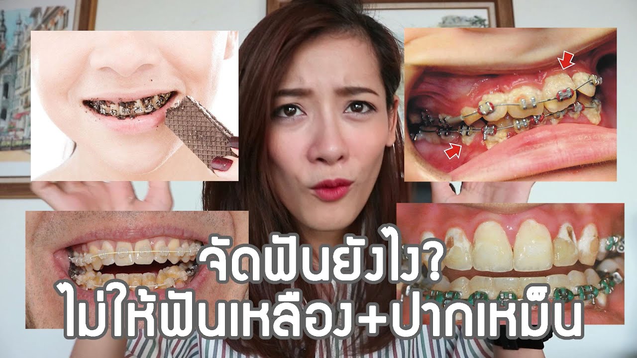 จัดฟันยังไงไม่ให้ ฟันเหลือง ปากเหม็น (วิธีทำความสะอาดสำหรับคนจัดฟัน)
