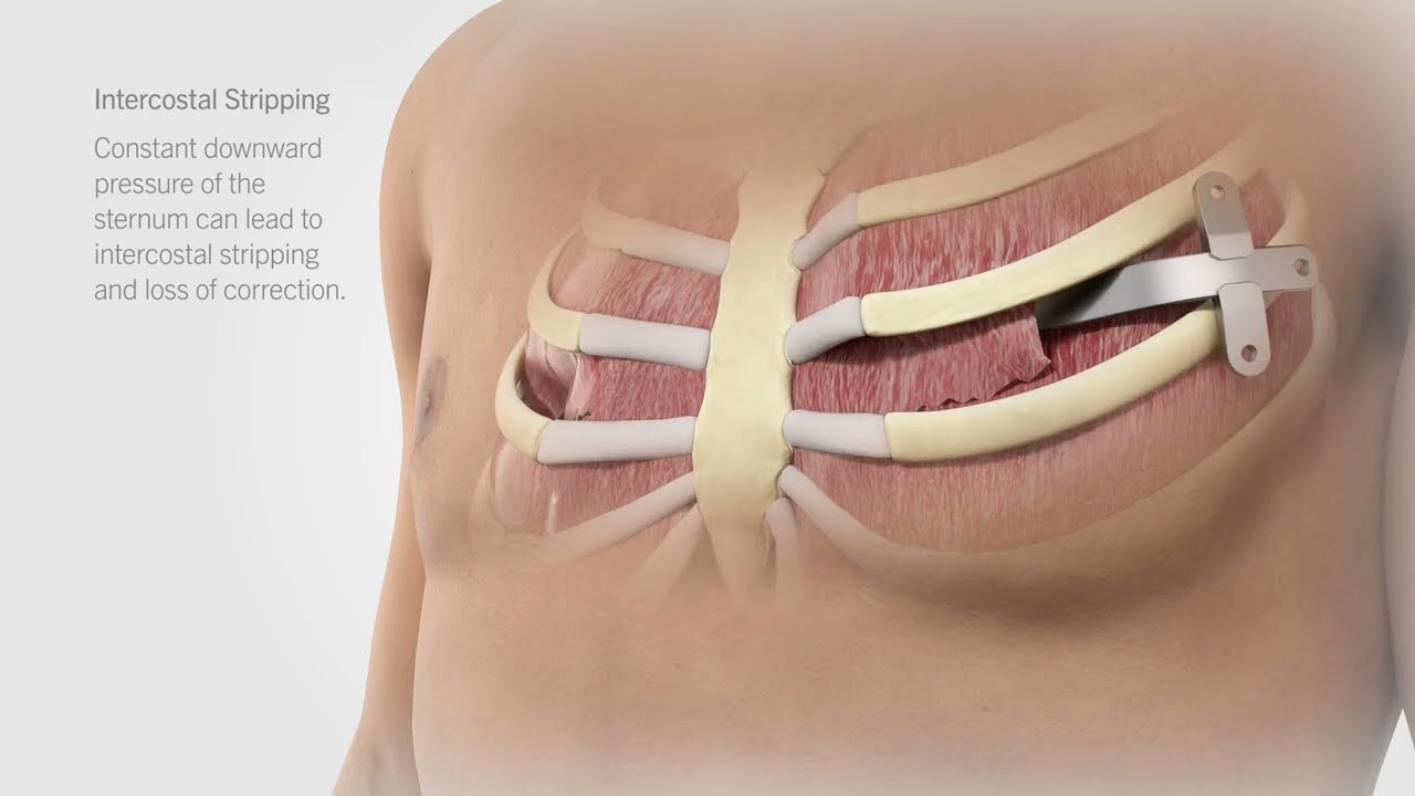 Pure Pectus - raising the bar in pectus repair