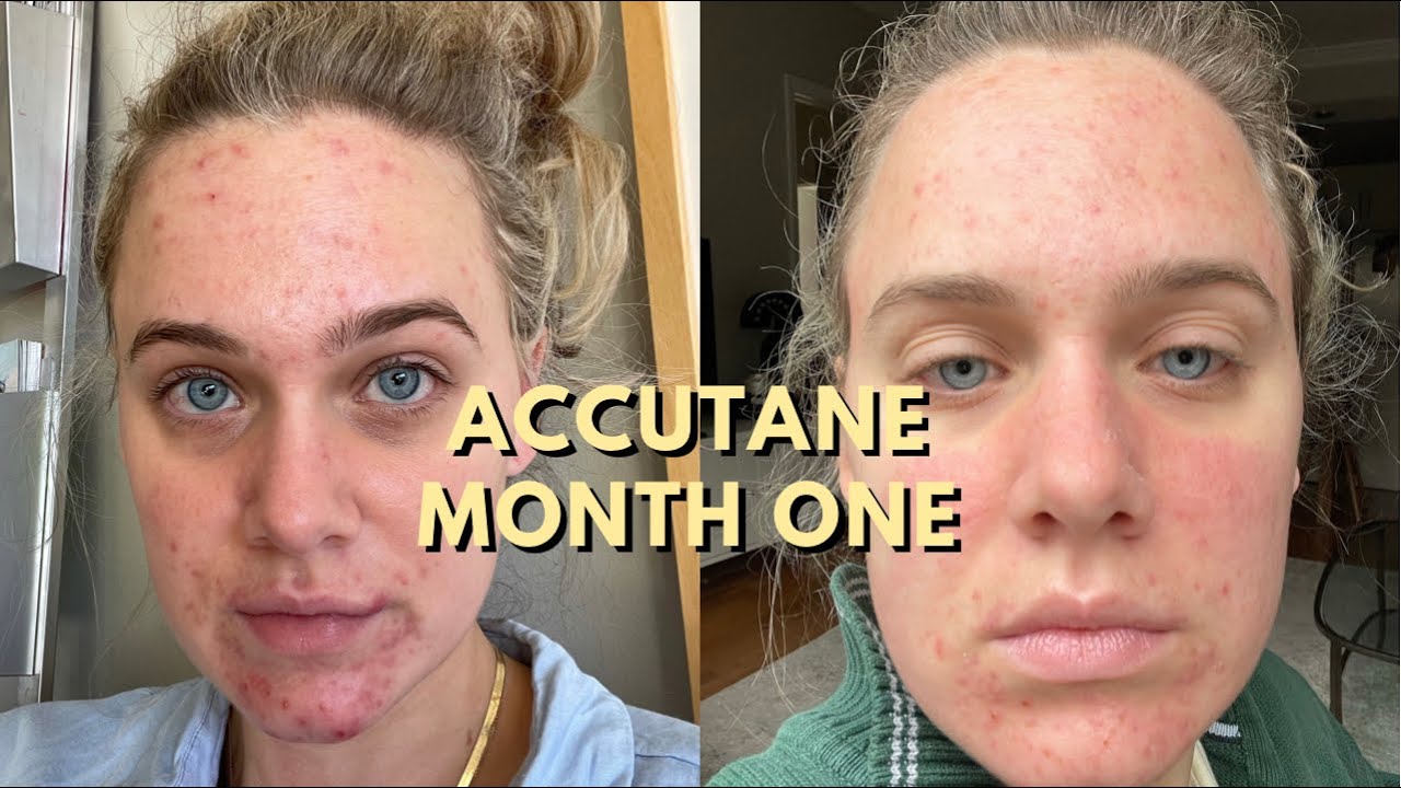 ACCUTANE JOURNEY Month 1 | Because Acne Sucks