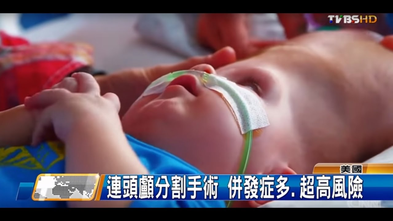 連頭顱分割手術 併發症多.超高風險  全球進行式 20161022 (2/3)