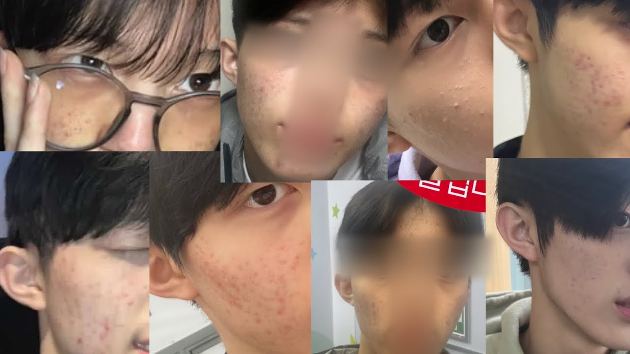 여드름 관리 방법 궁금해?