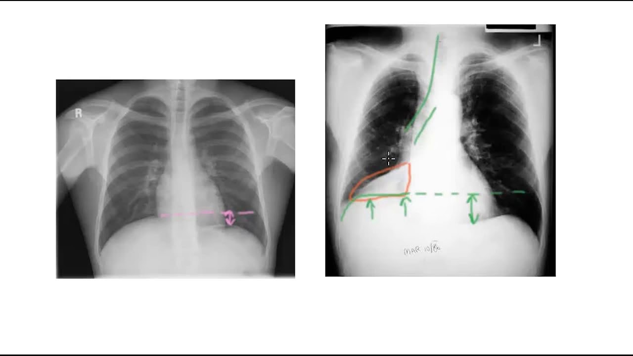 🔴  PNEUMONIE, PLEURESIE, INFARCTUS OU ATELECTASIE ?!