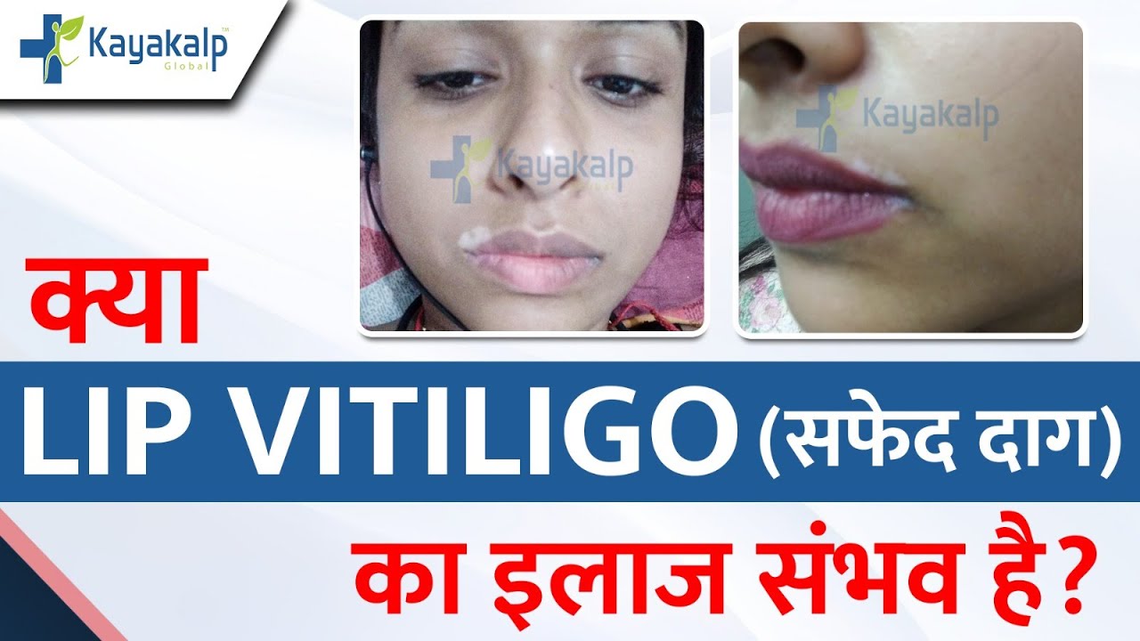 Lips Vitiligo Treatment in India | Case Study & Recovery Lip Vitiligo Patient | Kayakalp Global