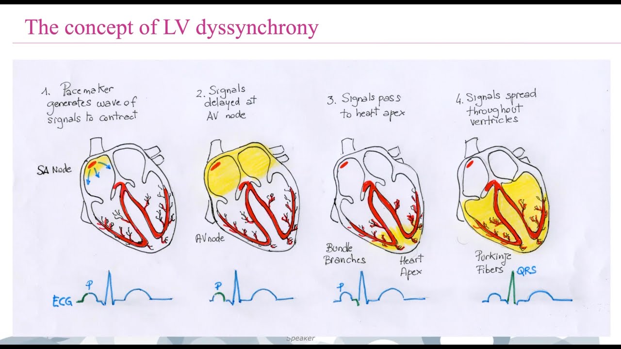 The role of nuclear cardiology in the evaluation of dyssynchrony