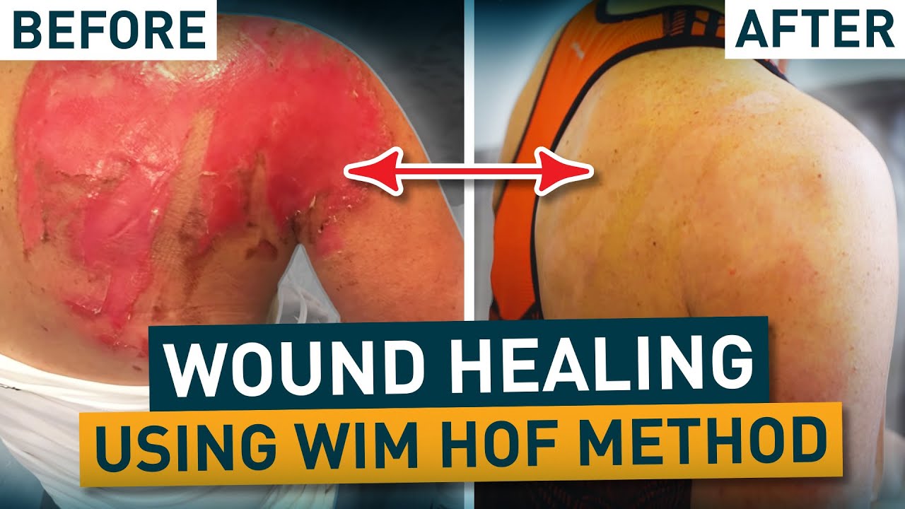 Progressive Wound Healing | Wim Hof Method