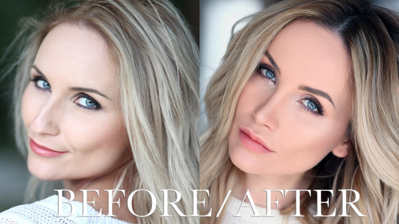 TOTUL DESPRE OPERATIA MEA DE RINOPLASTIE. BEFORE/AFTER