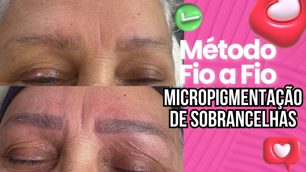 Micropigmentação em Sobrancelhas Fio a Fio Dermógrafo Após Remoção de Micro Antiga Resultado Natural