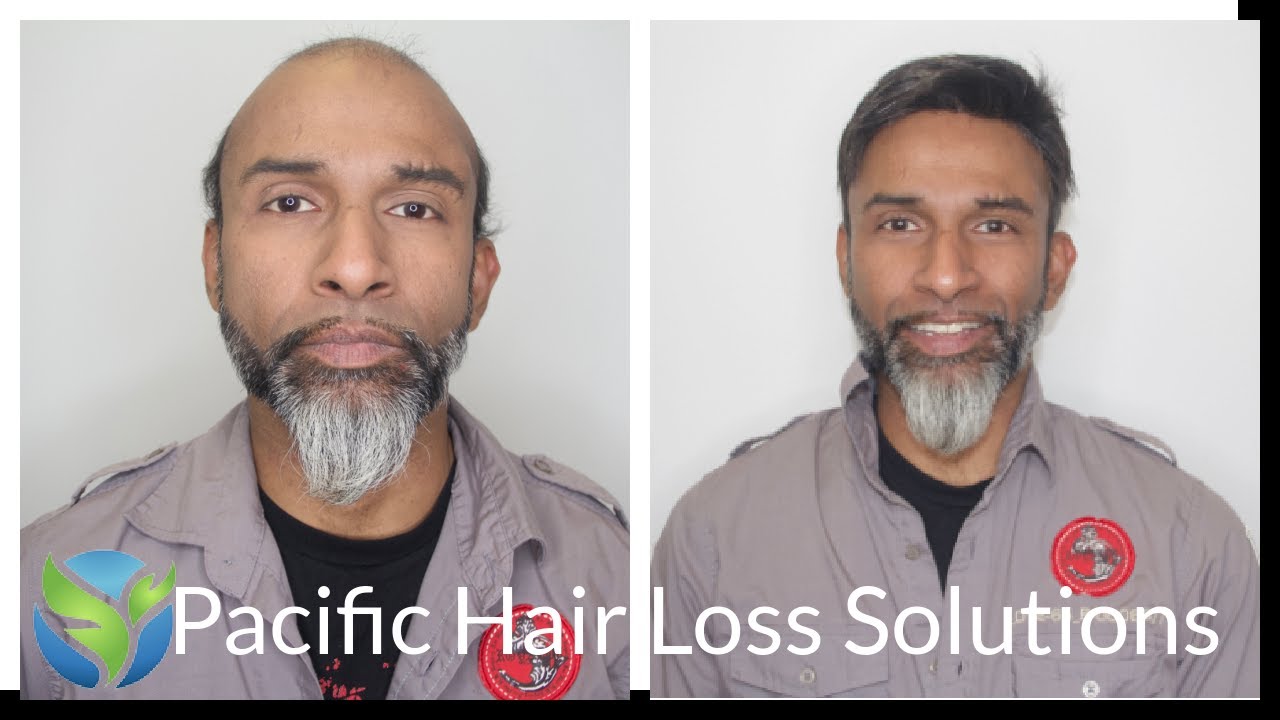 Realistic men's hair system install &ndash; Hair Loss, Baldness, Mens Wigs, Mens Toupees, Hair Pieces