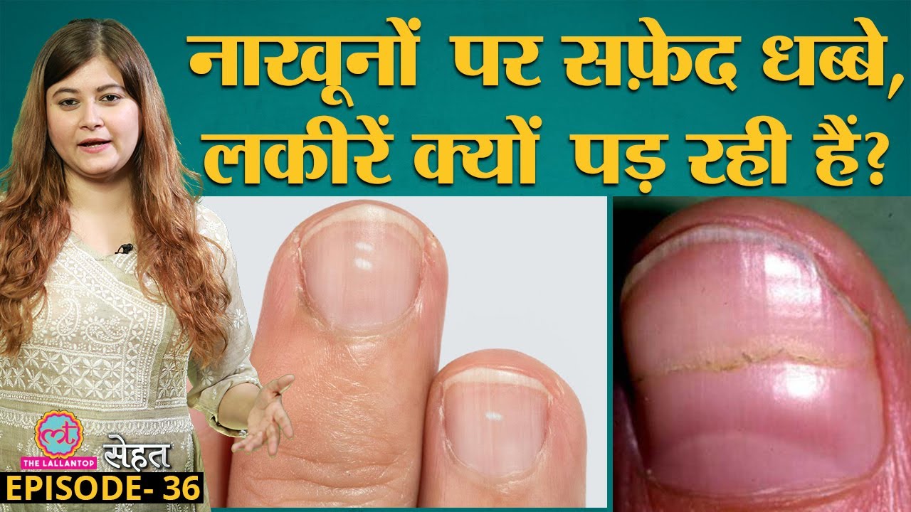 Nails पर White Spots, Beau's Lines, क्यों पड़ते हैं Doctors से समझिए | Sehat Ep 36