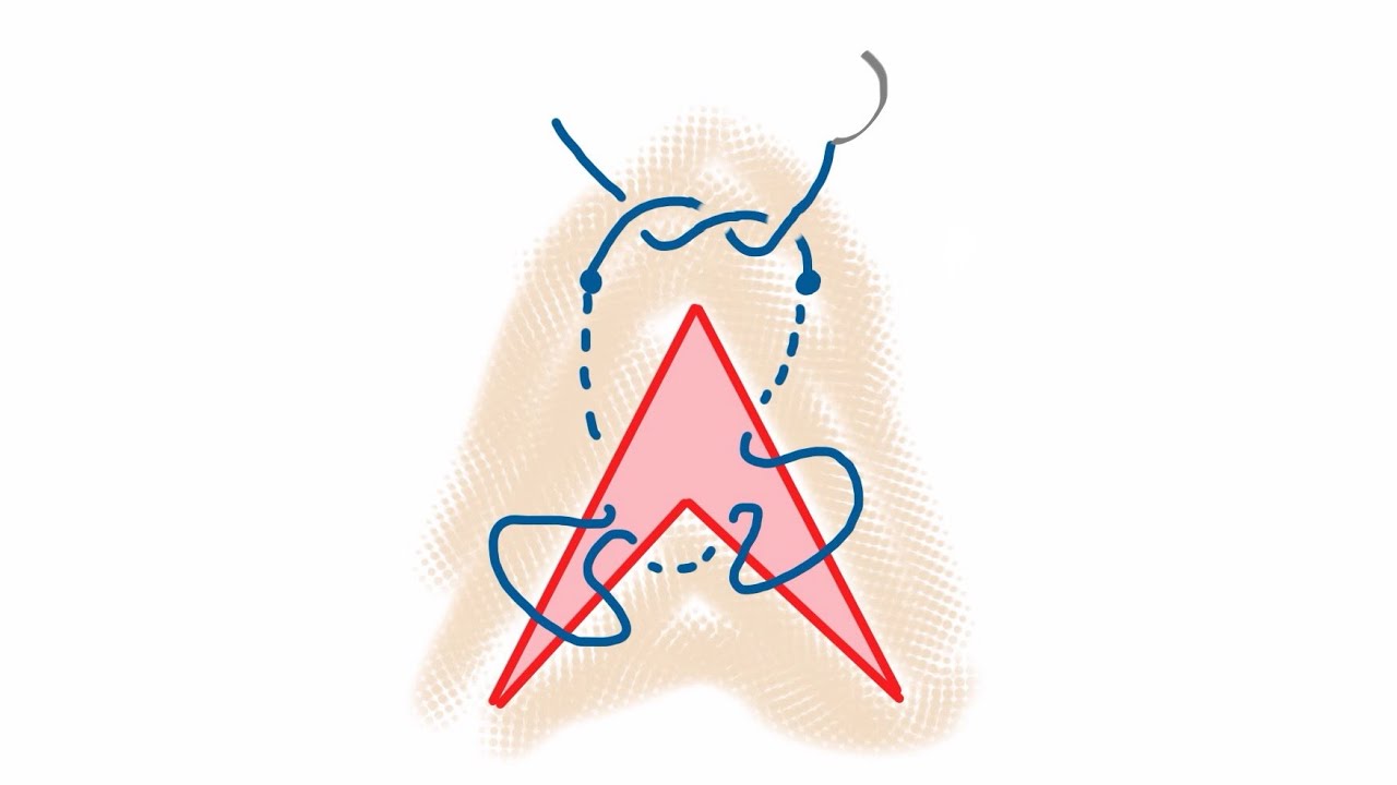 Suturing a V shaped wound filmed through GoogleGlass