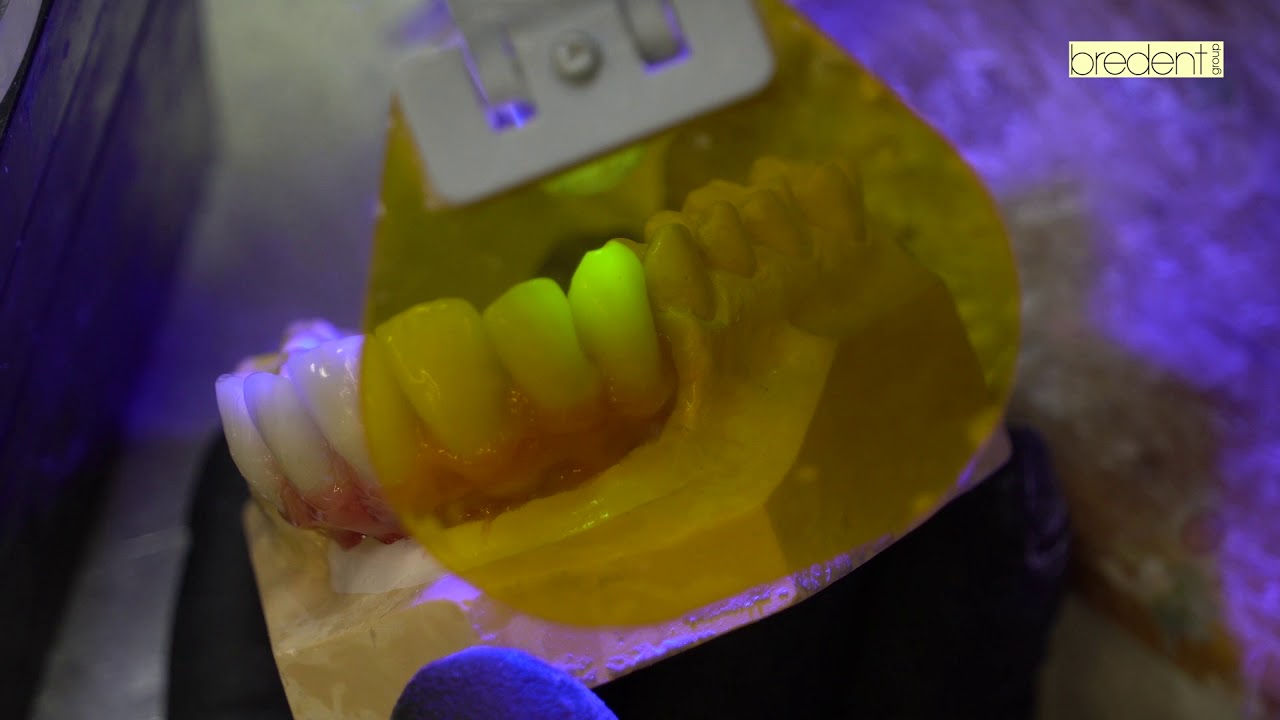 Prótesis dental fija: falsa encía