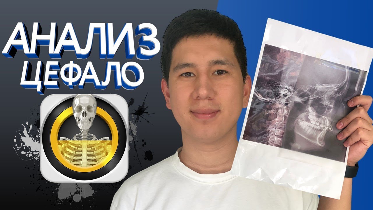АНАЛИЗ ЦЕФАЛО | ТРГ в ОРТОДОНТИИ