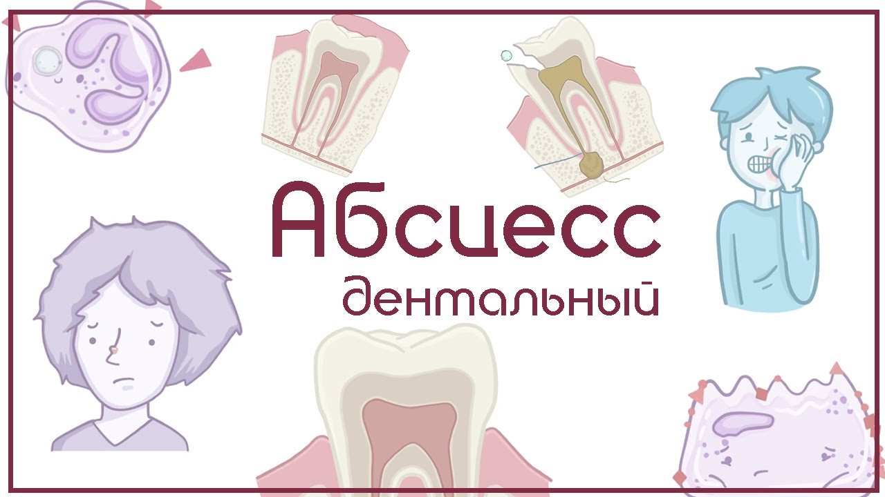 Дентальный абсцесс