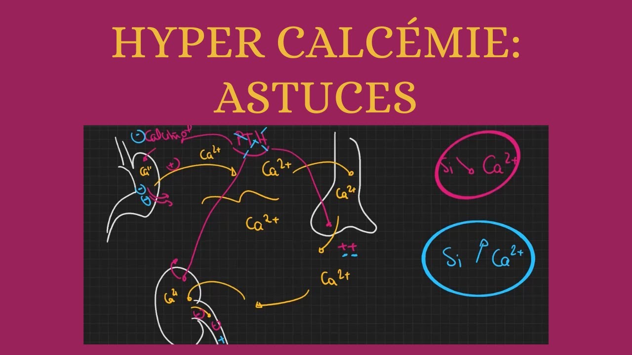 Hypercalcémie: toutes les astuces mémoire