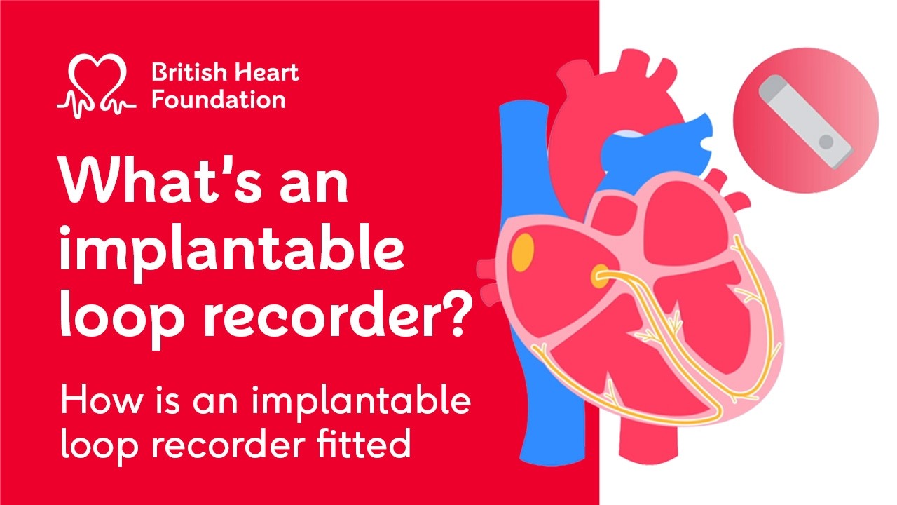 Understanding Implantable loop recorders